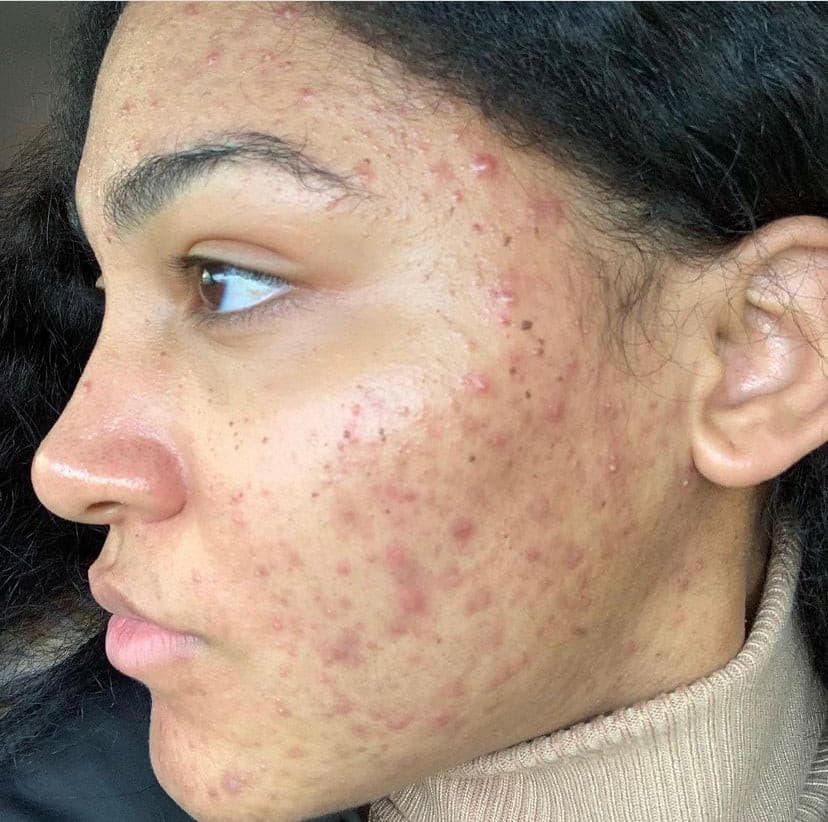Close-up of an individual's face experiencing acne and skin texture issues, highlighting the need for effective skincare solutions.