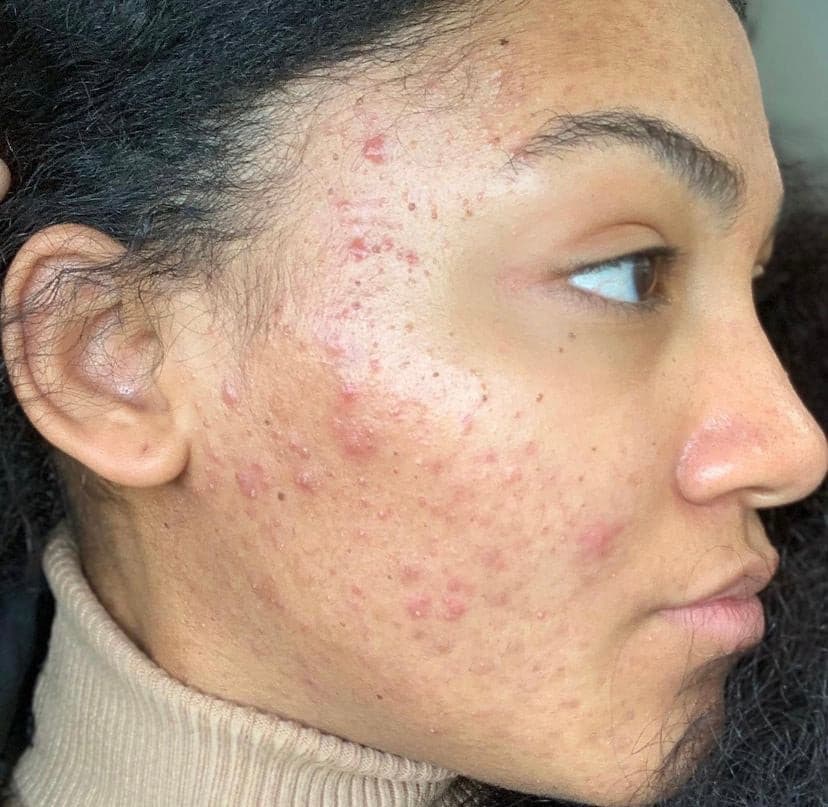 Skin with acne and redness, ideal for Vegan Antioxidant Facial Toner to soothe irritation and balance pH for a smoother complexion.
